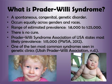 prada william syndrome|prader willi syndrome pictures adults.